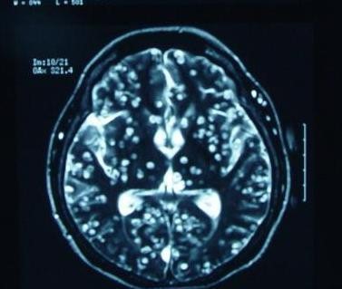 25 Epilepsia 3 - Clinica Neuron